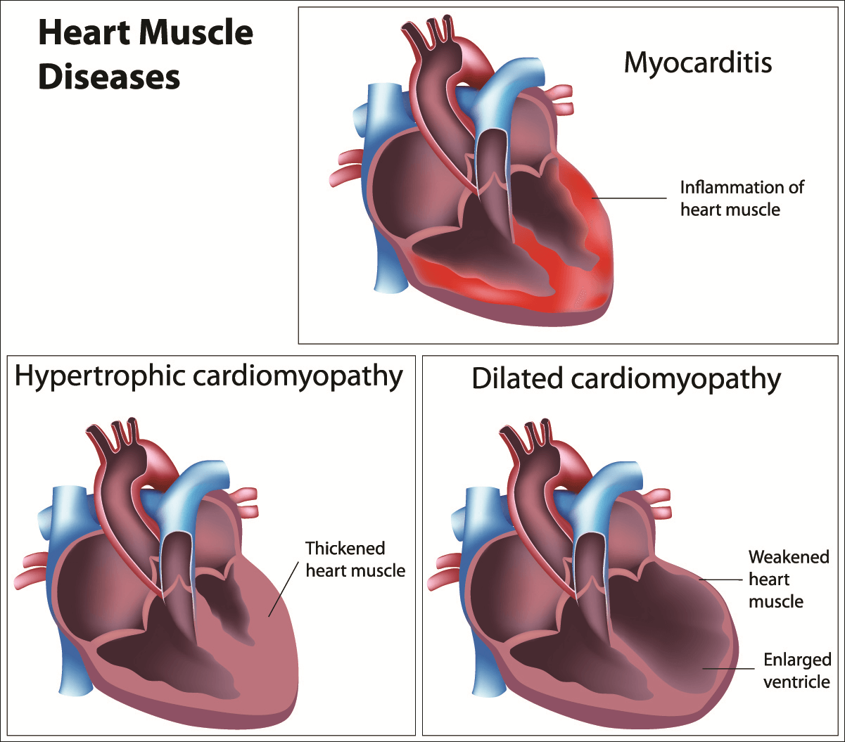 cardiomyopathy